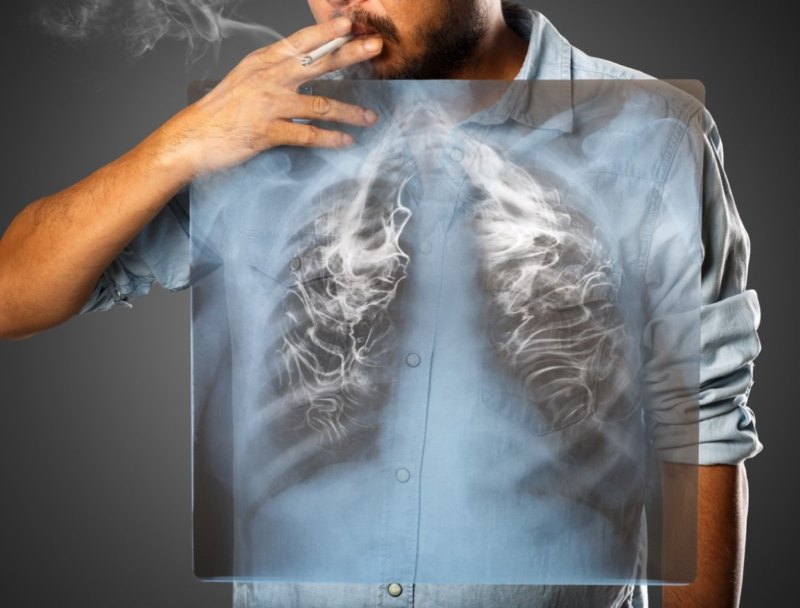 akciğer kanseri tedavisi